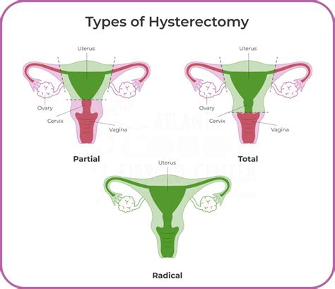 is total hysterectomy considered pwd